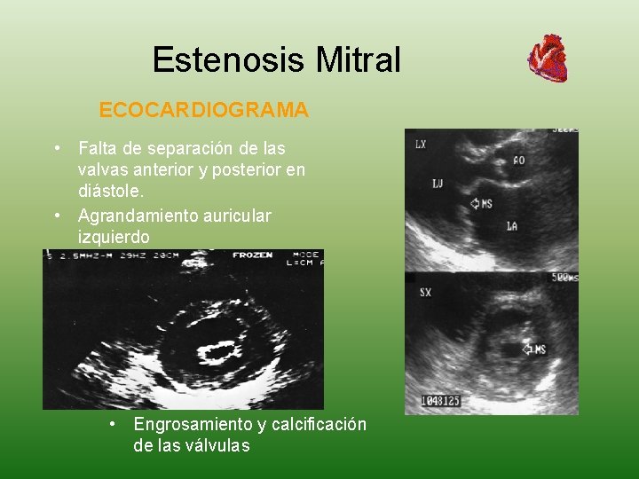 Estenosis Mitral ECOCARDIOGRAMA • Falta de separación de las valvas anterior y posterior en