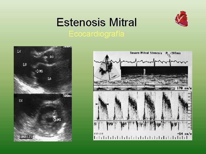 Estenosis Mitral Ecocardiografía 