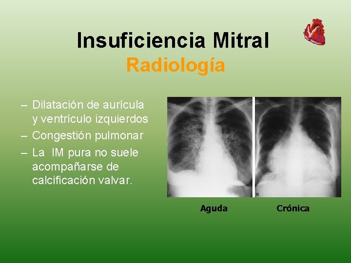 Insuficiencia Mitral Radiología – Dilatación de aurícula y ventrículo izquierdos – Congestión pulmonar –