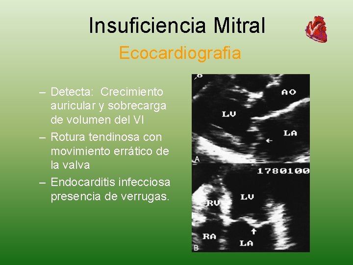 Insuficiencia Mitral Ecocardiografia – Detecta: Crecimiento auricular y sobrecarga de volumen del VI –