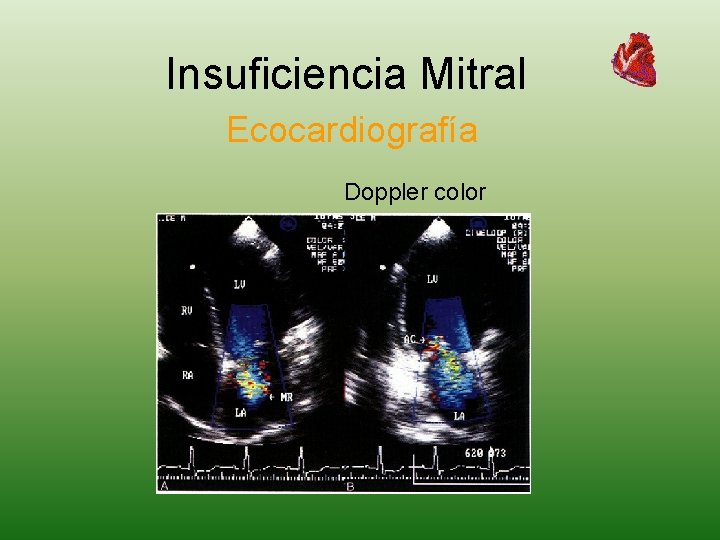 Insuficiencia Mitral Ecocardiografía Doppler color 
