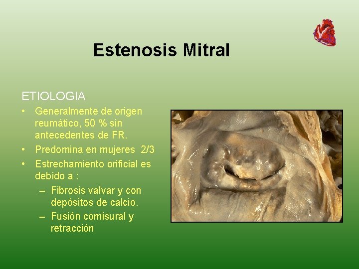 Estenosis Mitral ETIOLOGIA • Generalmente de origen reumático, 50 % sin antecedentes de FR.