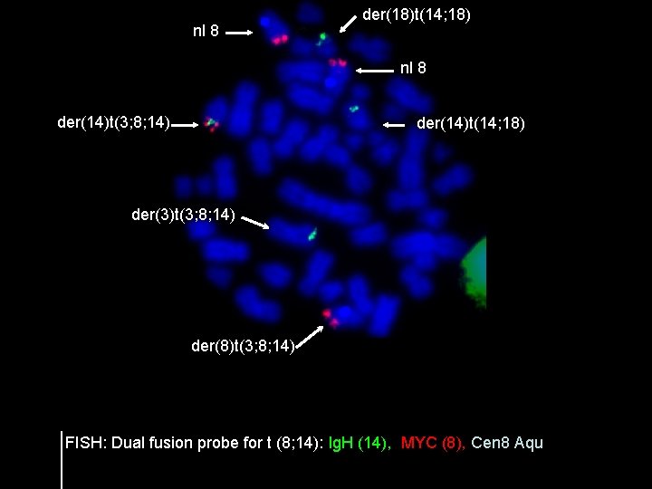 nl 8 der(18)t(14; 18) nl 8 der(14)t(3; 8; 14) der(14)t(14; 18) der(3)t(3; 8; 14)