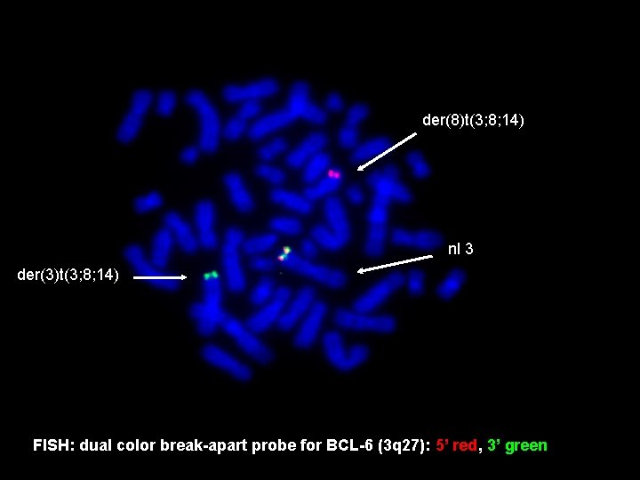 der(8)t(3; 8; 14) nl 3 der(3)t(3; 8; 14) FISH: dual color break-apart probe for