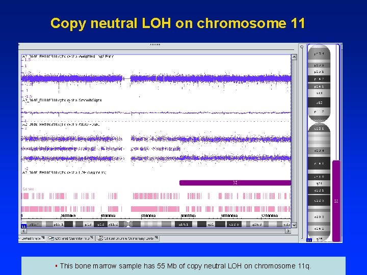 Copy neutral LOH on chromosome 11 § This bone marrow sample has 55 Mb