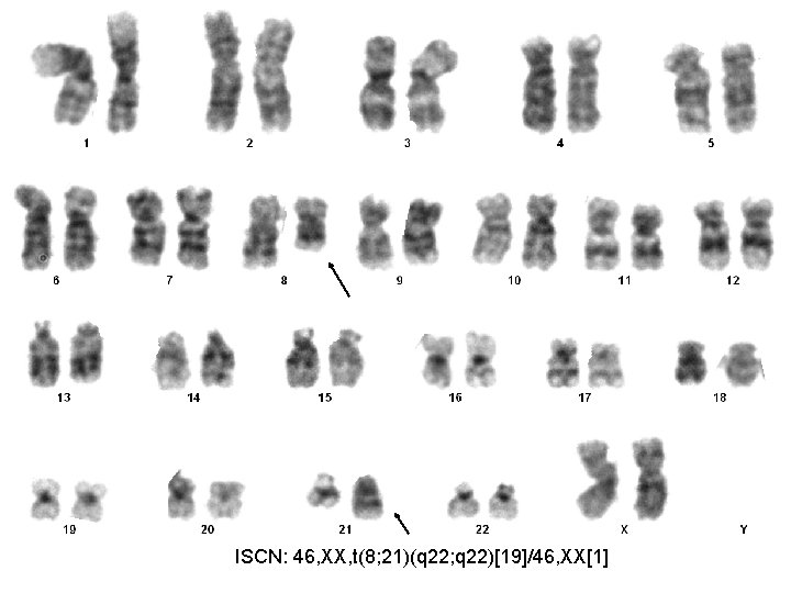 ISCN: 46, XX, t(8; 21)(q 22; q 22)[19]/46, XX[1] 