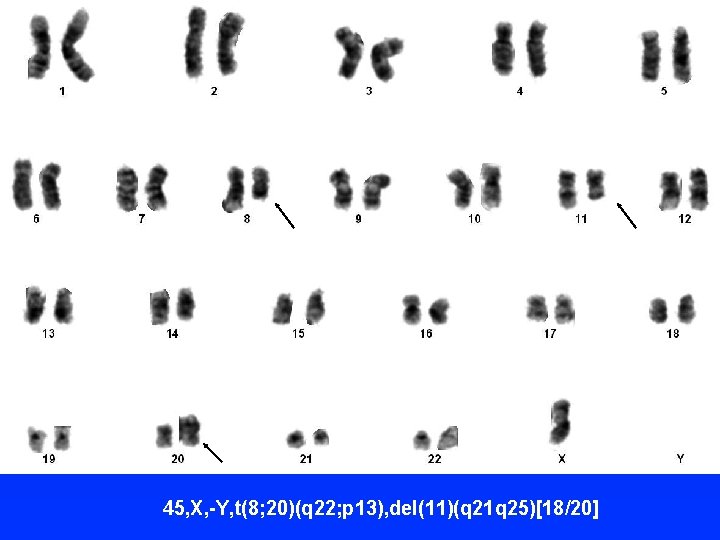 45, X, -Y, t(8; 20)(q 22; p 13), del(11)(q 21 q 25)[18/20] 