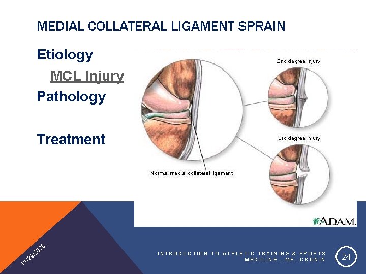 MEDIAL COLLATERAL LIGAMENT SPRAIN Etiology MCL Injury Pathology Treatment 20 1 0 /2 9