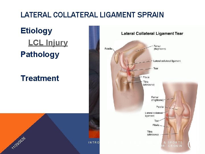 LATERAL COLLATERAL LIGAMENT SPRAIN Etiology LCL Injury Pathology Treatment 20 1 0 /2 9