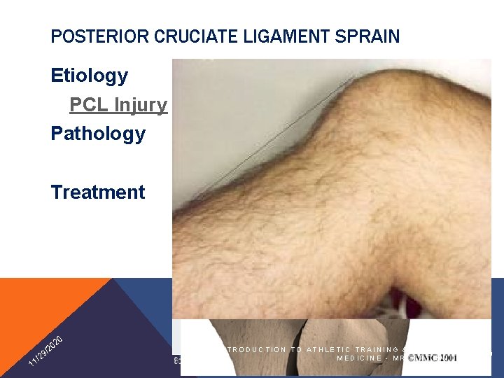 POSTERIOR CRUCIATE LIGAMENT SPRAIN Etiology PCL Injury Pathology Treatment 20 1 0 /2 9