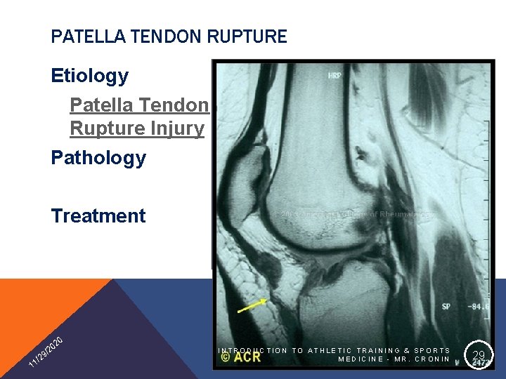 PATELLA TENDON RUPTURE Etiology Patella Tendon Rupture Injury Pathology Treatment 20 1 0 /2