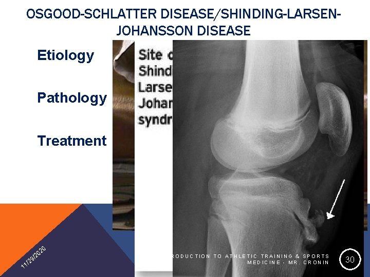 OSGOOD-SCHLATTER DISEASE/SHINDING-LARSENJOHANSSON DISEASE Etiology Pathology Treatment 20 1 0 /2 9 2 1/ INTRODUCTION