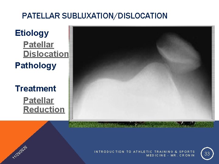 PATELLAR SUBLUXATION/DISLOCATION Etiology Patellar Dislocation Pathology Treatment Patellar Reduction 20 1 0 /2 9