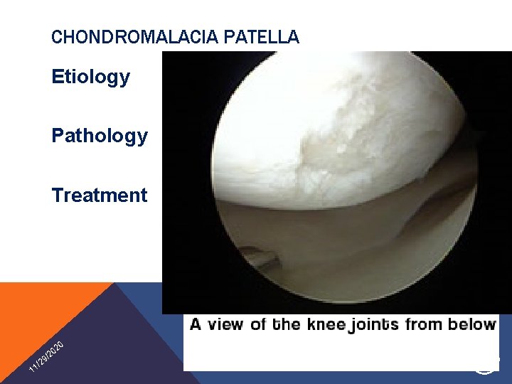 CHONDROMALACIA PATELLA Etiology Pathology Treatment 20 1 0 /2 9 2 1/ INTRODUCTION TO