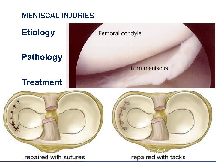 MENISCAL INJURIES Etiology Pathology Treatment 20 1 0 /2 9 2 1/ INTRODUCTION TO