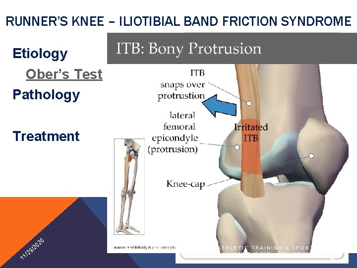 RUNNER’S KNEE – ILIOTIBIAL BAND FRICTION SYNDROME Etiology Ober’s Test Pathology Treatment 20 1