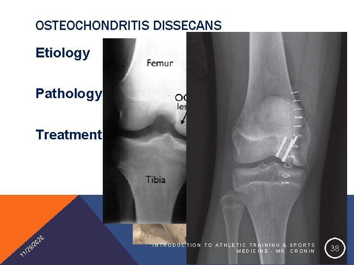 OSTEOCHONDRITIS DISSECANS Etiology Pathology Treatment 20 1 0 /2 9 2 1/ INTRODUCTION TO