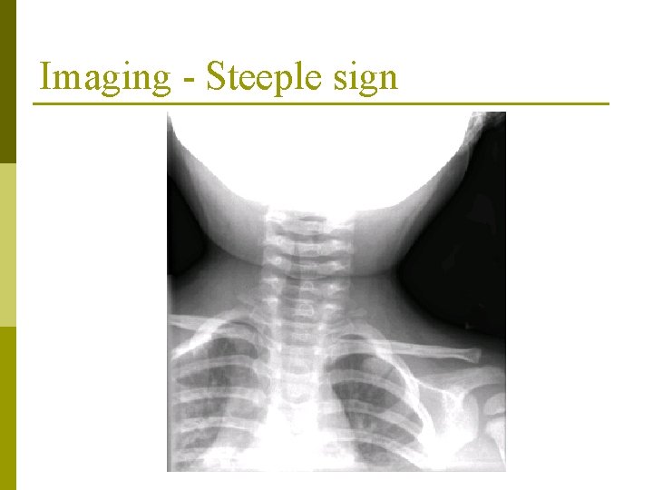 Imaging - Steeple sign Imaging - Steeple sign