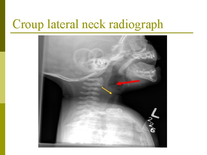 Croup lateral neck radiograph Croup lateral neck radiograph