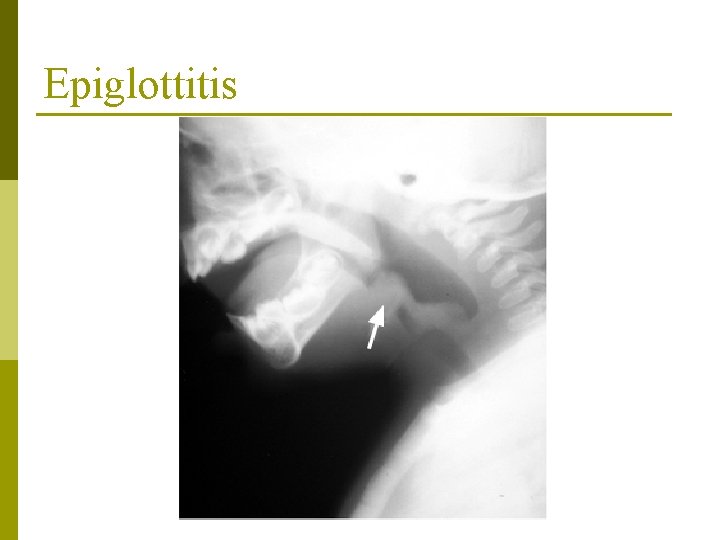 Epiglottitis Epiglottitis