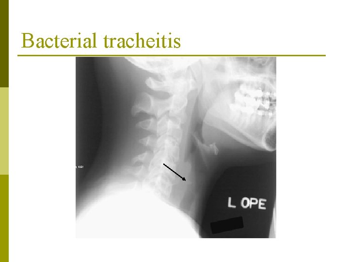 Bacterial tracheitis Bacterial tracheitis