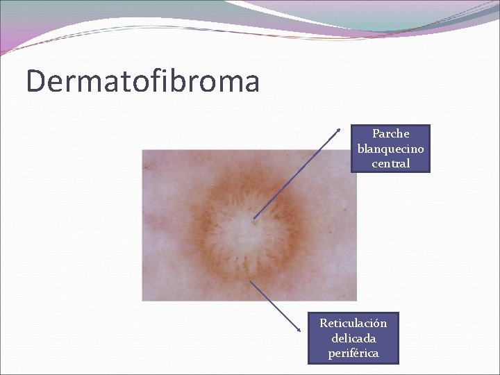 Dermatofibroma Parche blanquecino central Reticulación delicada periférica 