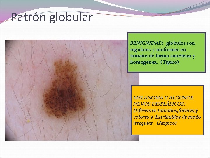 Patrón globular BENIGNIDAD: glóbulos son regulares y uniformes en tamaño de forma simétrica y