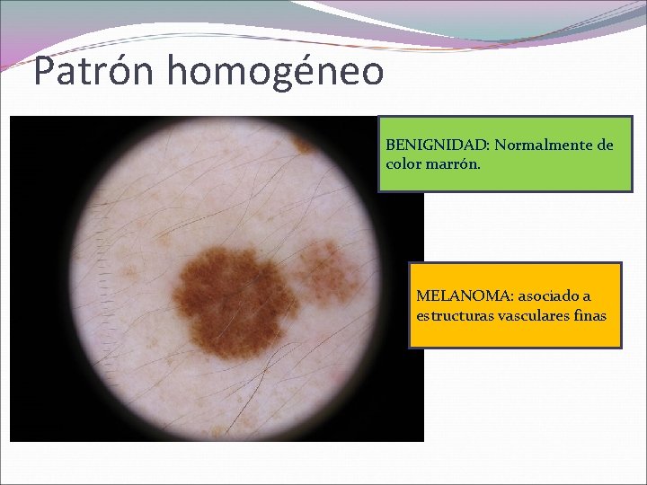 Patrón homogéneo BENIGNIDAD: Normalmente de color marrón. MELANOMA: asociado a estructuras vasculares finas 