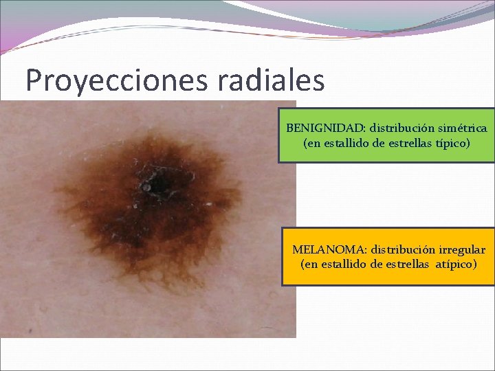 Proyecciones radiales BENIGNIDAD: distribución simétrica (en estallido de estrellas típico) MELANOMA: distribución irregular (en