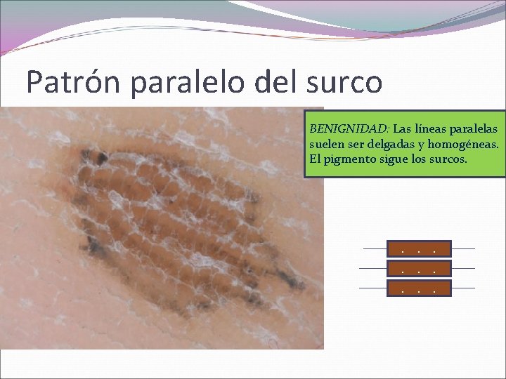 Patrón paralelo del surco BENIGNIDAD: Las líneas paralelas suelen ser delgadas y homogéneas. El