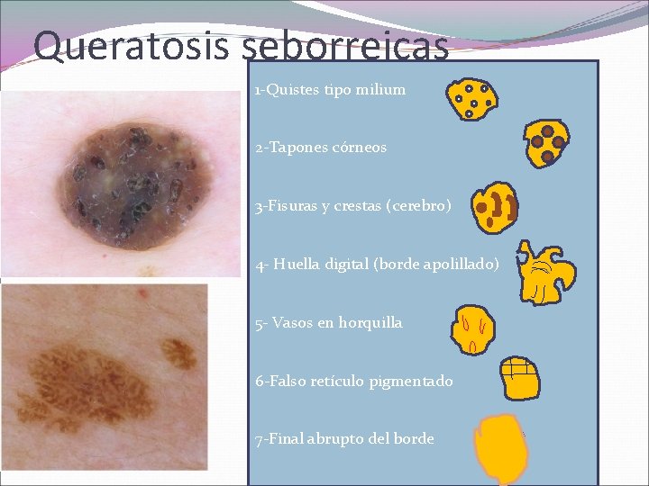 Queratosis seborreicas 1 -Quistes tipo milium 2 -Tapones córneos 3 -Fisuras y crestas (cerebro)