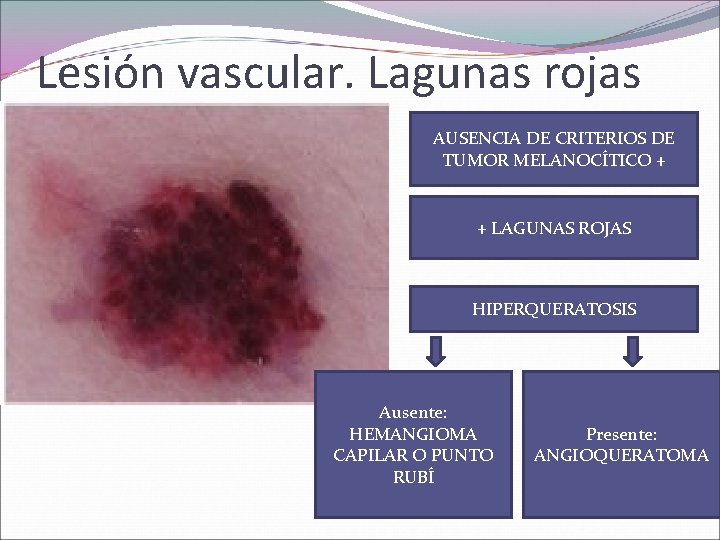 Lesión vascular. Lagunas rojas AUSENCIA DE CRITERIOS DE TUMOR MELANOCÍTICO + + LAGUNAS ROJAS
