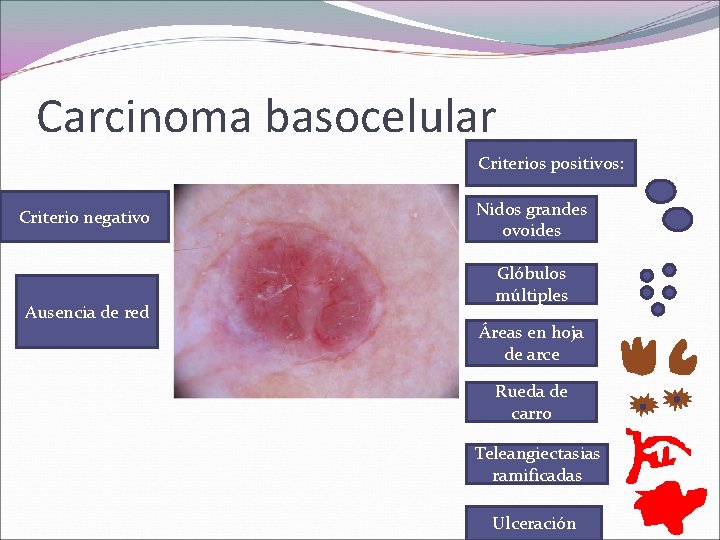 Carcinoma basocelular Criterios positivos: Criterio negativo Ausencia de red Nidos grandes ovoides Glóbulos múltiples