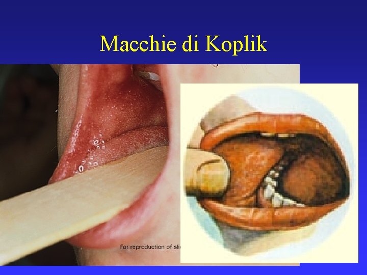 Macchie di Koplik 