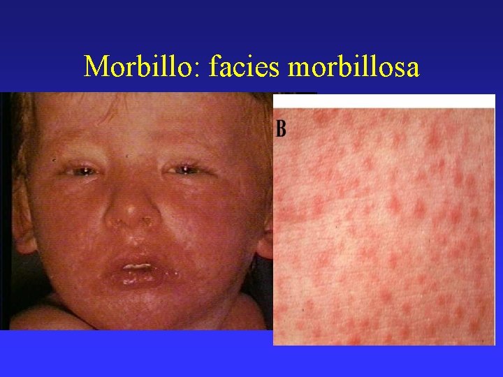 Morbillo: facies morbillosa 