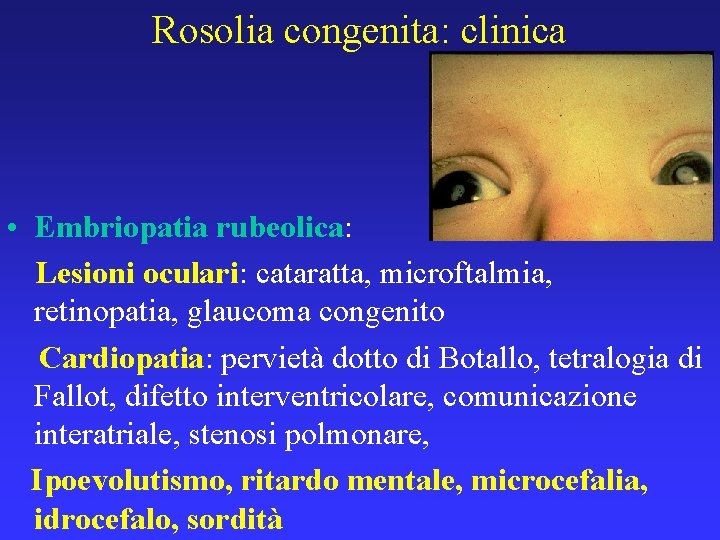 Rosolia congenita: clinica • Embriopatia rubeolica: Lesioni oculari: cataratta, microftalmia, retinopatia, glaucoma congenito Cardiopatia: