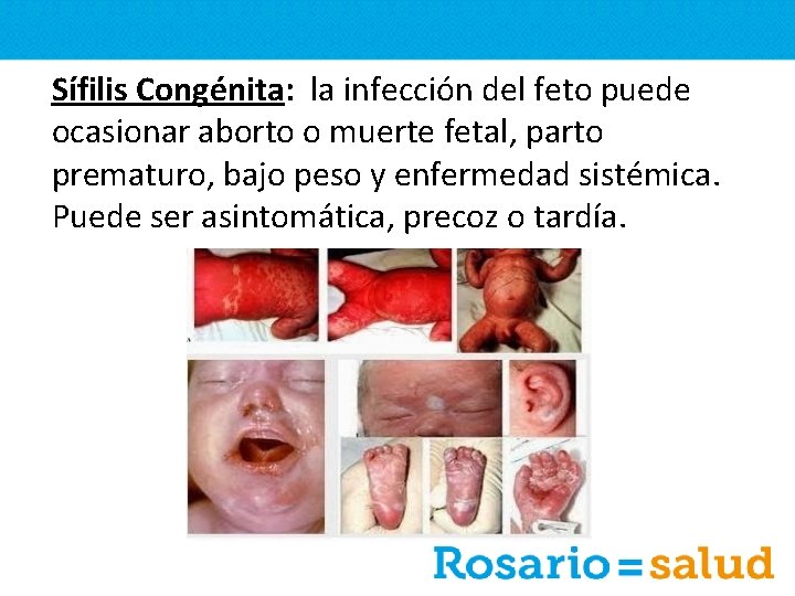 Sífilis Congénita: la infección del feto puede ocasionar aborto o muerte fetal, parto prematuro,