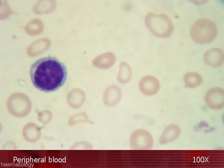 Peripheral blood 100 X 