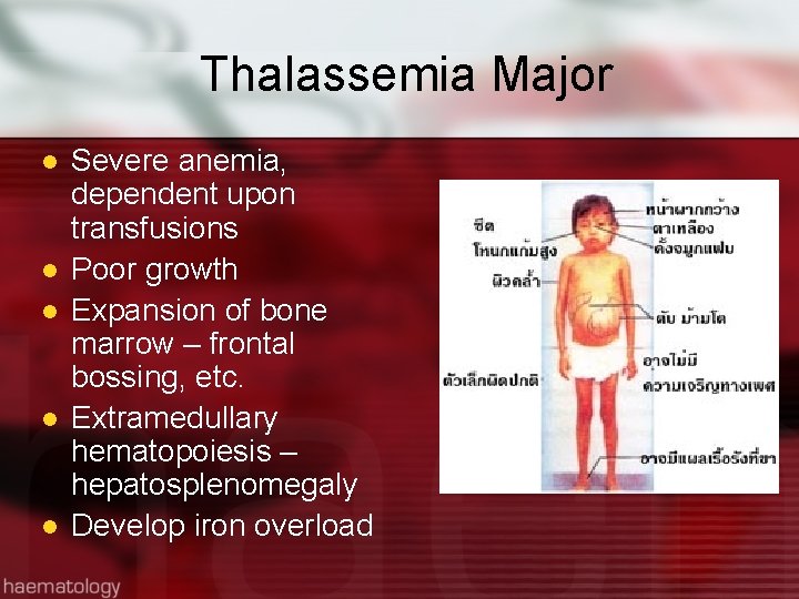 Thalassemia Major l l l Severe anemia, dependent upon transfusions Poor growth Expansion of