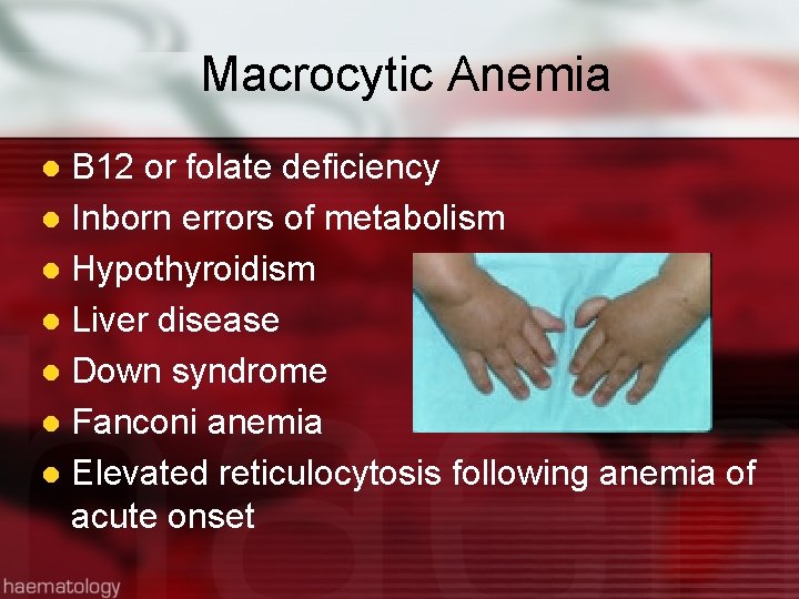 Macrocytic Anemia B 12 or folate deficiency l Inborn errors of metabolism l Hypothyroidism
