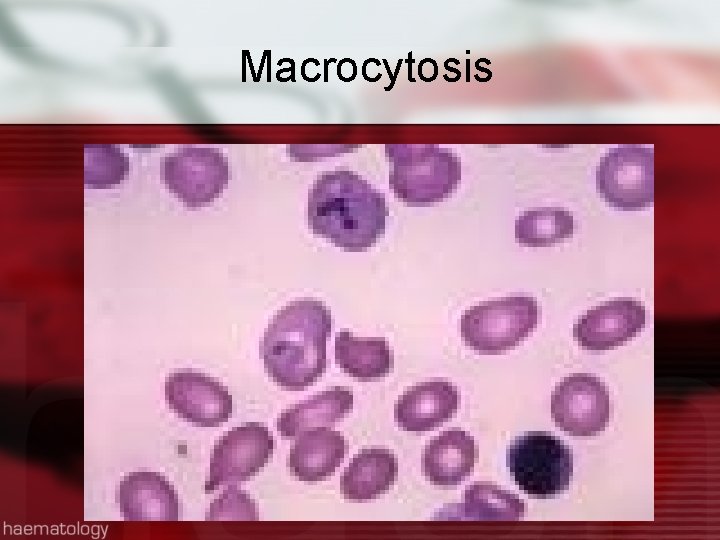 Macrocytosis 