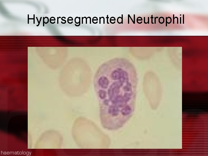 Hypersegmented Neutrophil 