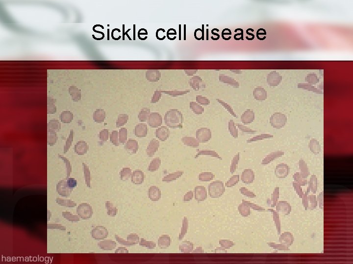 Sickle cell disease 