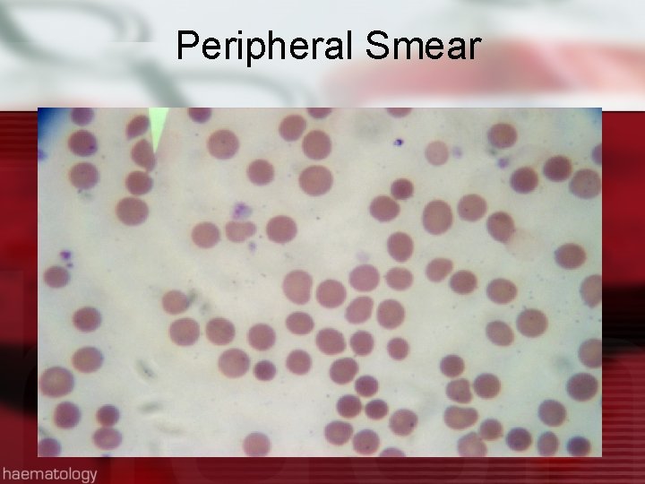 Peripheral Smear 