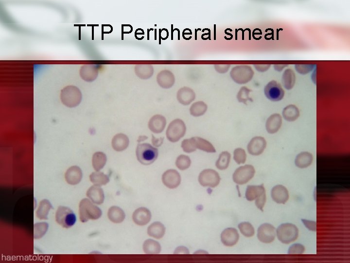 TTP Peripheral smear 