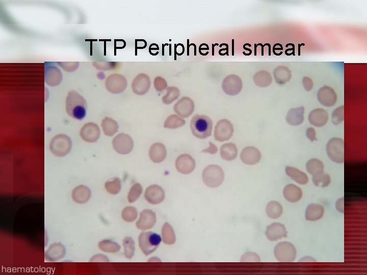 TTP Peripheral smear 