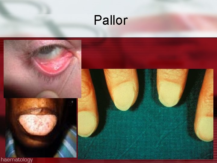 Pallor 