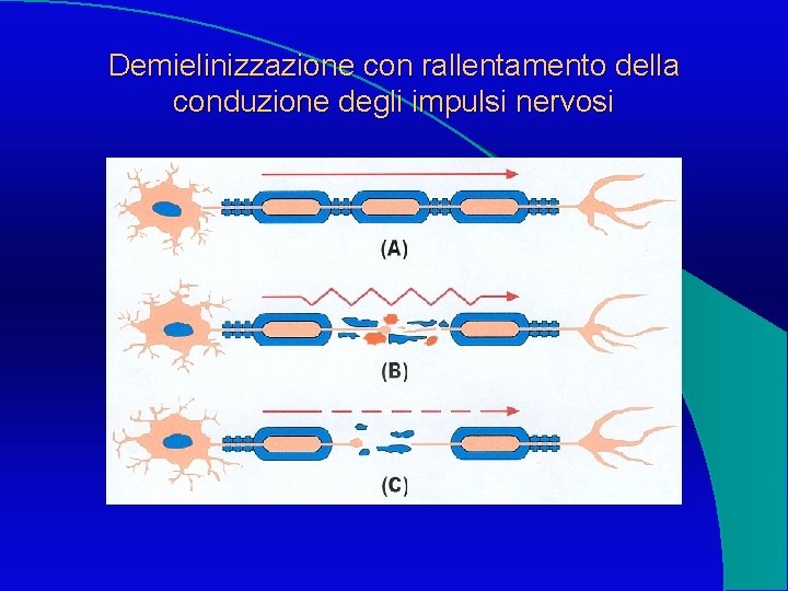 Demielinizzazione con rallentamento della conduzione degli impulsi nervosi 