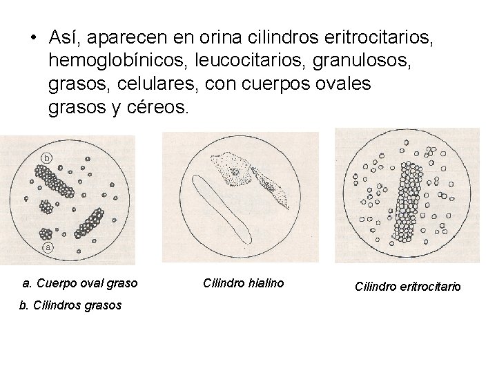  • Así, aparecen en orina cilindros eritrocitarios, hemoglobínicos, leucocitarios, granulosos, grasos, celulares, con