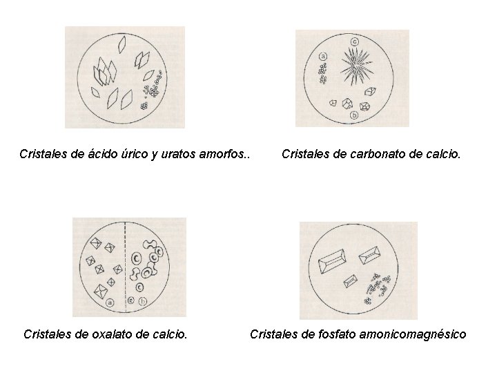 Cristales de ácido úrico y uratos amorfos. . Cristales de oxalato de calcio. Cristales